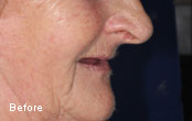 Cosmetic Dentures Before After Pics